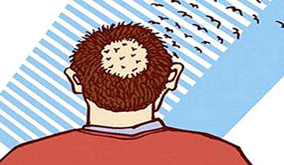 斑秃是什么原因造成的？斑秃怎么治疗？