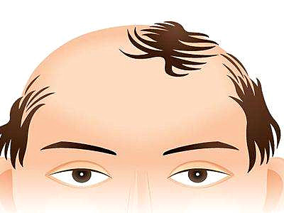 人到中年容易秃顶的5大原因！