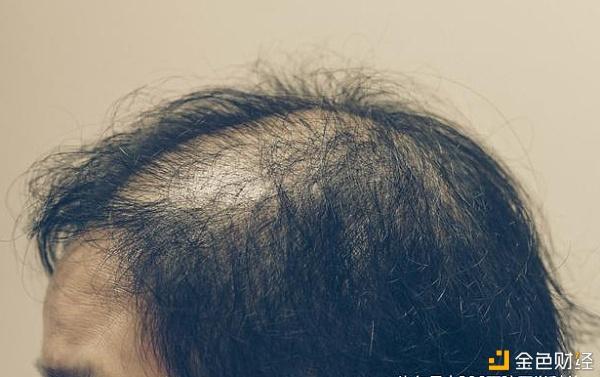 脂溢性脱发怎么治疗最有效 脂溢性脱发竟然好了