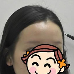 广州倍生做眉毛种植手术，相比纹眉的效果还是更好一些吧
