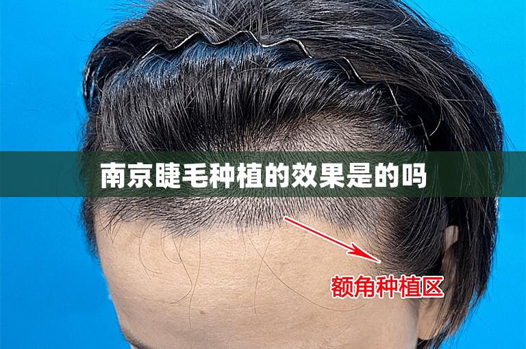 南京睫毛种植的效果是的吗