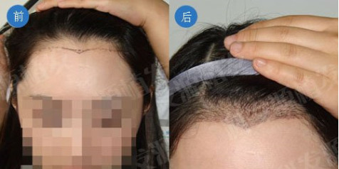 美人尖种植会留下疤痕吗？科发源做植发怎么样？