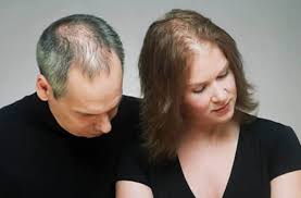 激光治脱发——美国生发黑科技，老爸和老公的脱发有救了！