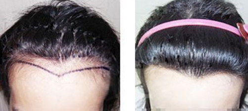 植发医生的手法好坏，对植发后效果大吗？