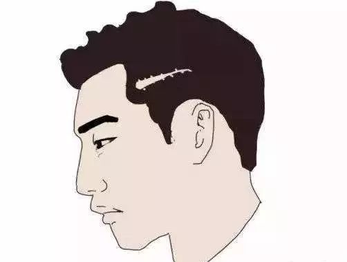 头皮疤痕型脱发该怎么办？可以进行植发吗？