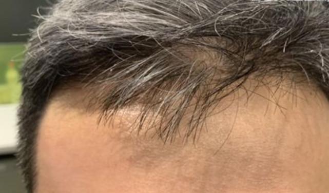 英国26岁男子图便宜土耳其植发4个月后头发没长出来
