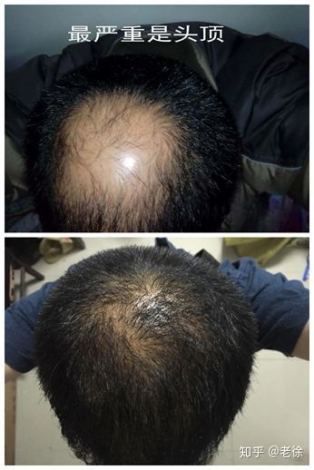 遗传的脂溢性脱发是否可以通过植发手术来完全治愈？