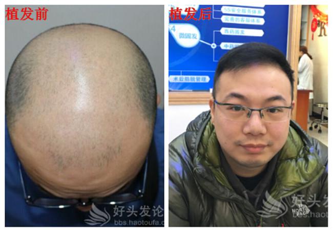 一位6级脱发者的植发“求生”历程
