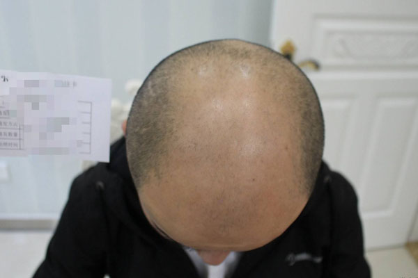 杭州治疗溢脂性脱发的医院