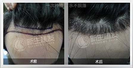 广州新生植发医院种植发际线手术可靠吗？
