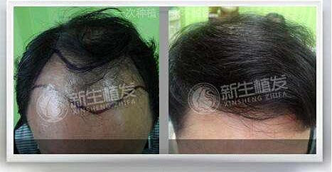 在杭州种植毛发哪家医院比较好