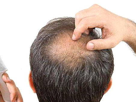 植发医院专家讲解：什么样的脱发可以植发？