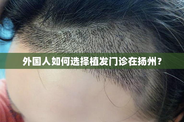 外国人如何选择植发门诊在扬州？