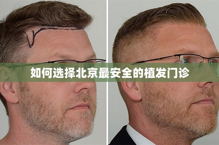 如何选择北京最安全的植发门诊