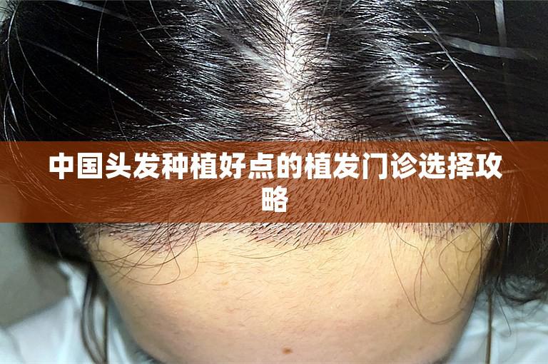中国头发种植好点的植发门诊选择攻略