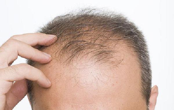 秃顶植发手术后可以达到什么样的效果