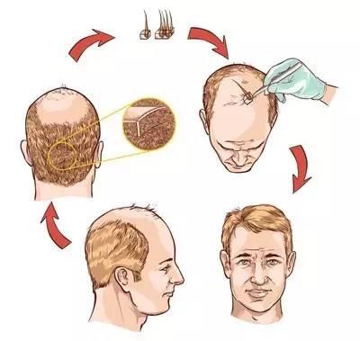 植发手术用的毛囊可以使用别人的吗？
