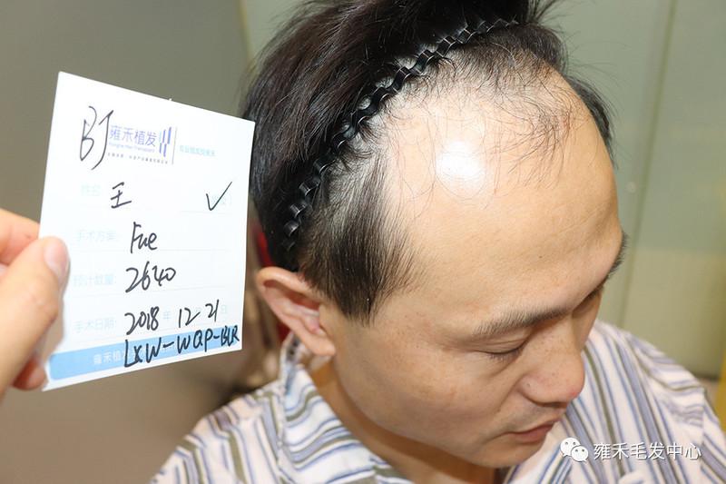 王先生是70后都是脱发了着急植发