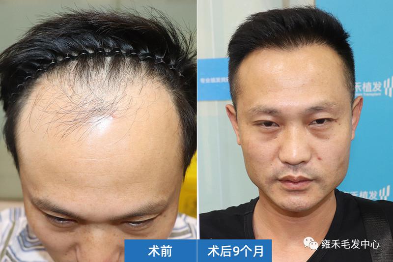 王先生是70后都是脱发了着急植发