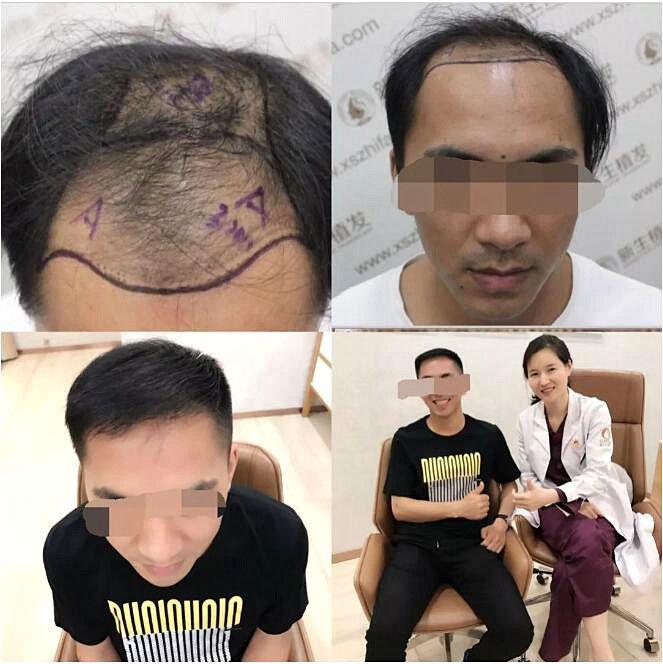 【植发案例】前额 头顶部植发 术后9个月效果满意