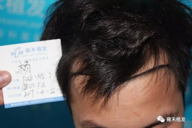 温州雍禾植发团队采用FUE为小杨植发2090单位