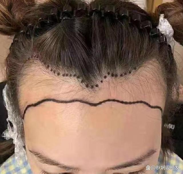 26岁姑娘一个人从深圳跑到北京做植发，做完就后悔了