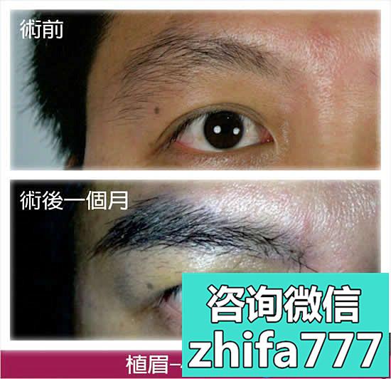 中国台湾dr。liu植发中心植眉案例 男性植眉400毛效果