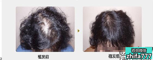 女性植发效果不如男性植发吗？这种情况是真的吗？