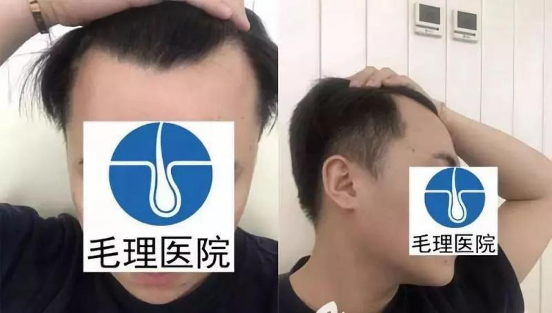 韩国毛理医院做鬓角植发种植发际线图片