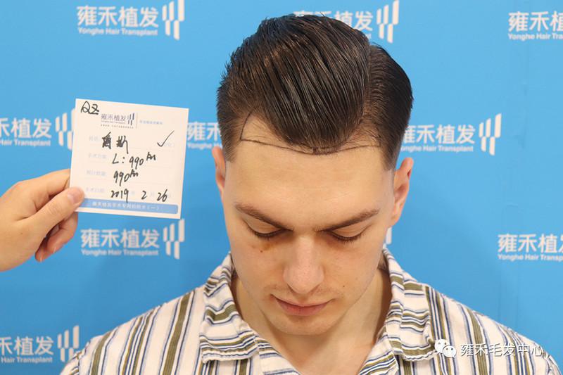 乌克兰植发帅哥秃了一点在中国植发1050毛囊