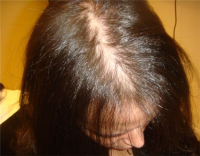 雄激素性脱发和什么疾病有关
