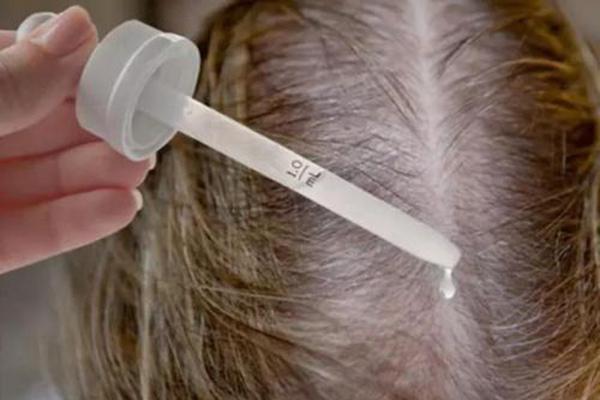米诺地尔治疗脂溢性脱发的效果