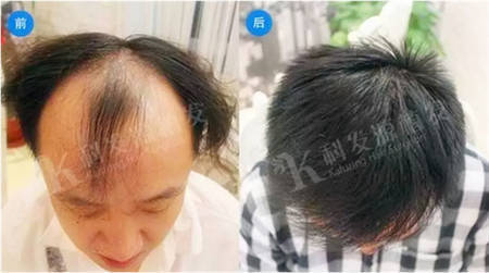 头发种植上海植发3838单位术后7个月