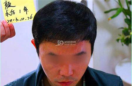 男士上海毛发移植展现1年植发效果