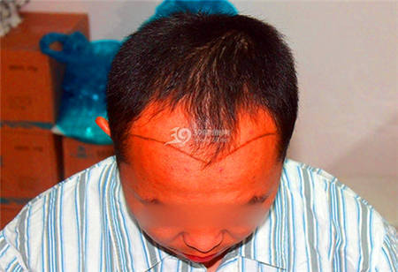 男士上海毛发移植展现1年植发效果
