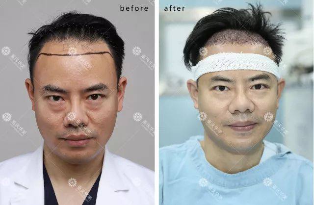 30岁秃整形医生植发过程大曝光！