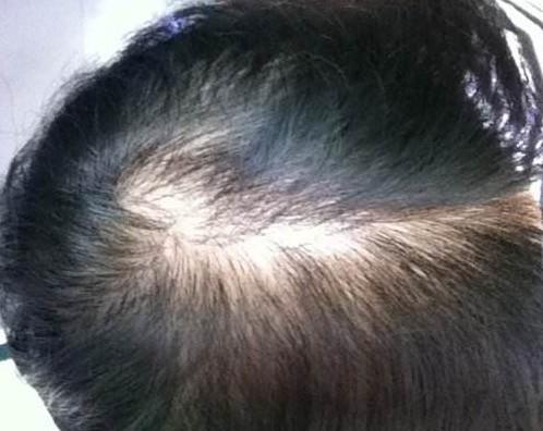 脂溢性脱发真的是因为头油引起的吗