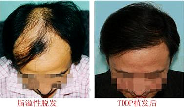 杭州毛发移植手术的价格是多少