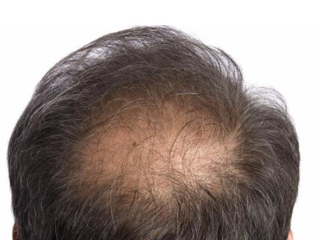 油脂性脱发是永久性的吗