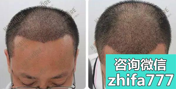 给大家展示m型发际线的男生在上海植发4000单位效果图