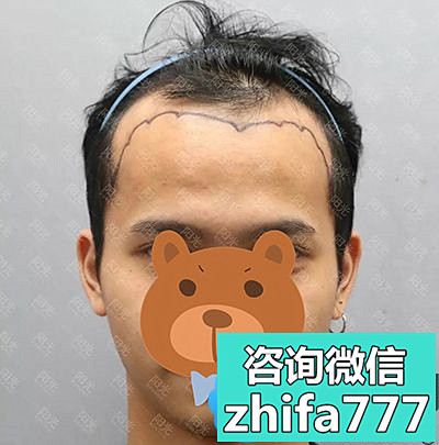 17岁小哥到深圳阳光采用4D微创植发种植发际线3000毛囊过程图