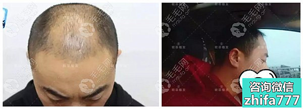 天津欧菲植发案例：4级脂溢性脱发植发3000毛囊单位补额角