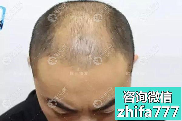 天津欧菲植发案例：4级脂溢性脱发植发3000毛囊单位补额角
