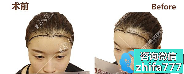 晒晒我的植发效果图，大家看我在广州植发际线花一万多贵不