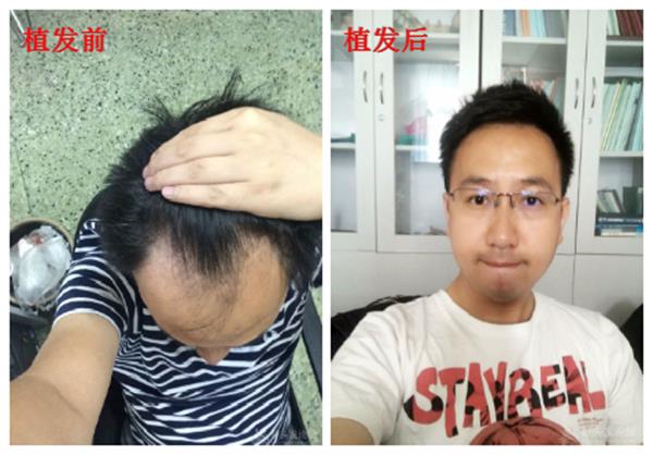 告别三级M型脱发北京植发让我对生活充满期待！