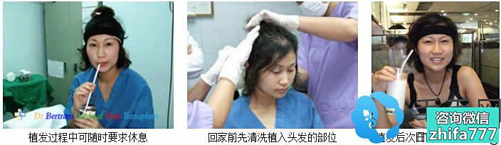 上海申江医院植发中心帮助Sara成功植发
