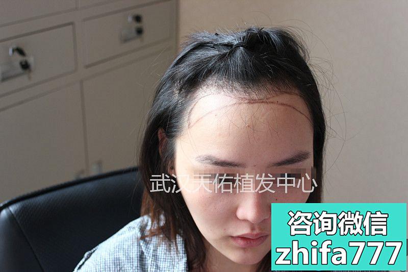 武汉天佑植发中心对女性先天性发际线高施术效果