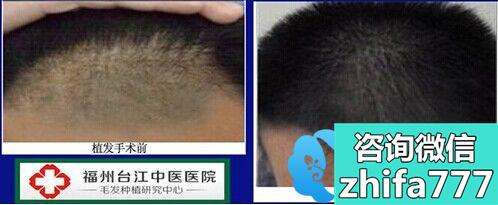 福州台江中医院毛发种植中心男性头发加密案例
