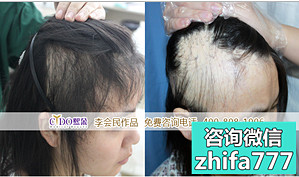 北京熙朵疤痕植发案例 女性疤痕脱发种植头发效果