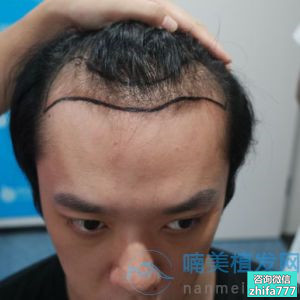 北京碧莲盛发际线种植，植发做的很成功